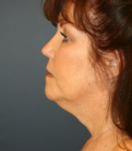 Feel Beautiful - Necklift and Lips - Before Photo